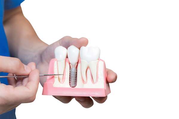 Can You Get Dental Implants if You Have Gum Disease from Maitland Square Dentistry in Maitland, FL