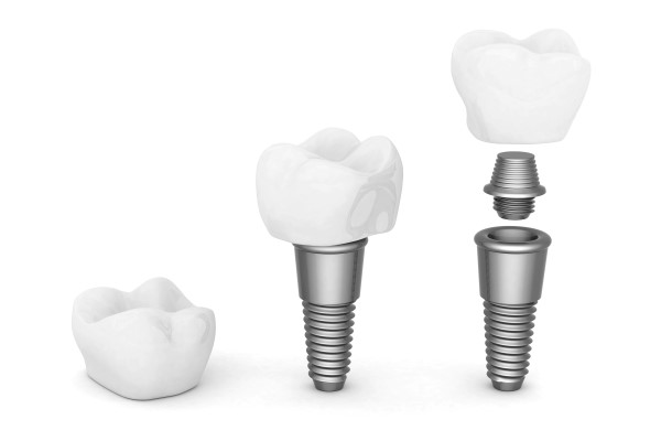 A Cosmetic Dentist Explains Dental Implant Restoration