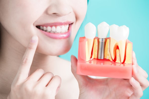 Ask A General Dentist: Who Is A Good Candidate For Dental Implants?