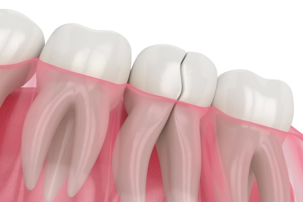 Repair A Cracked Tooth: Dental Restoration Options