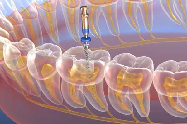 When You Should Consider An Endodontics Treatment