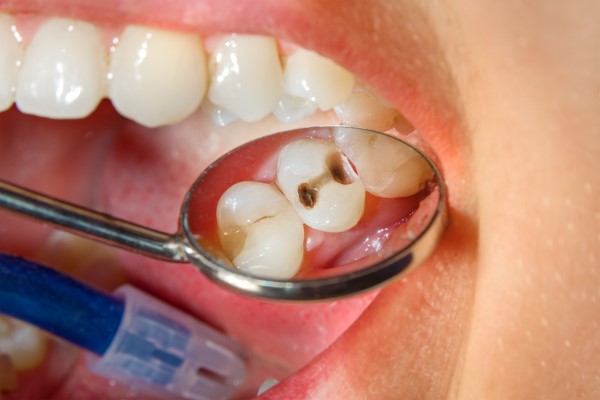 How Visiting A Family Dentist Can Prevent Cavities