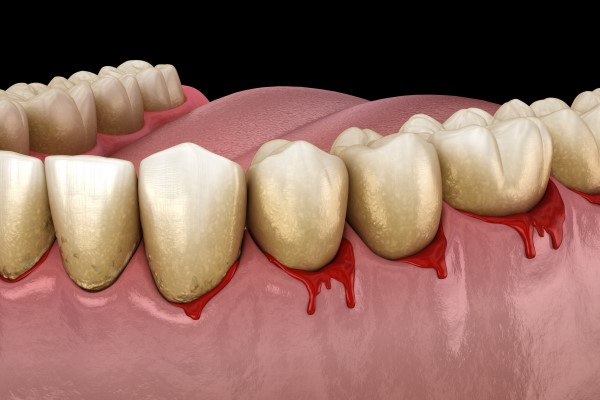 Bleeding Gums And The Stages Of Gum Disease