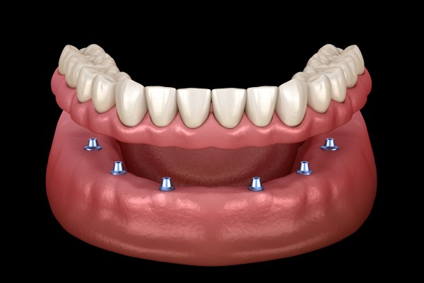 The Pros And Cons Of Implant Dentures