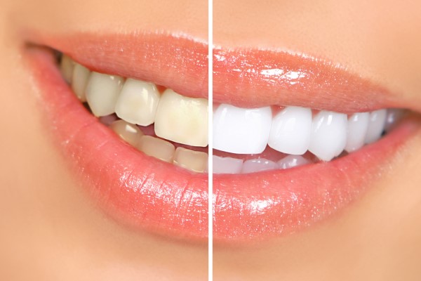 How To Reduce Sensitivity With Teeth Whitening Trays