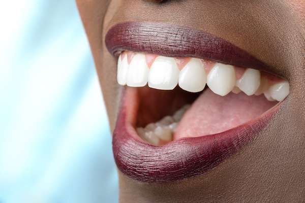Routine Dental Care: What Are Tooth Colored Fillings from Maitland Square Dentistry in Maitland, FL